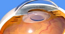 白内障の手術に使われる眼内レンズ「アイハンス」とは