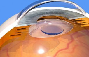 白内障の手術に使われる眼内レンズ「アイハンス」とは