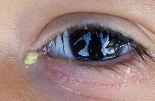 白内障と目やにの関係。目やにが多いのは白内障の症状？