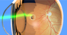 網膜裂け目の周りのレーザー光凝固