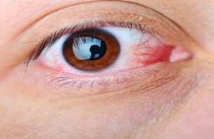 ステロイド点眼薬と白内障リスク：予防策と適切な使用方法について