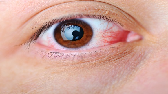 ステロイド点眼薬と白内障リスク：予防策と適切な使用方法について